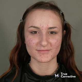 True Corrective: Chiara TC19 • Master Class di Make Up Online su Acne Cistica con sfumature Moda Duochrome e base Full Coverage